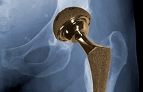 Biomet Metal-on-Metal Hip Implant Lawsuits