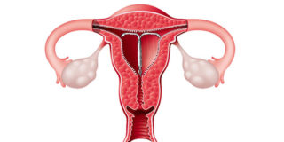 Mirena IUD Hysterectomy