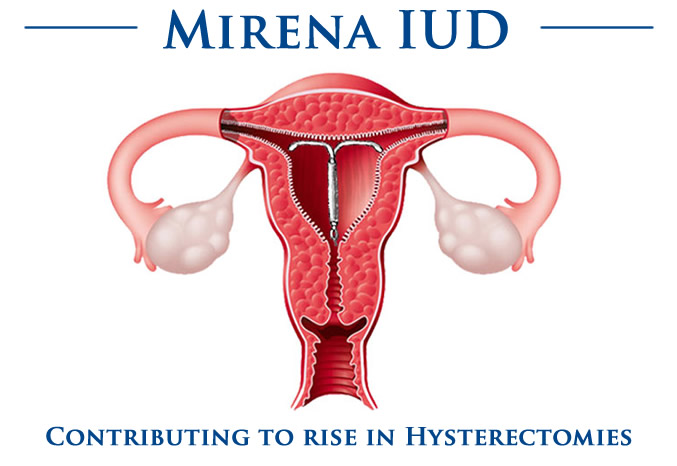 Mirena IUD Hysterectomy